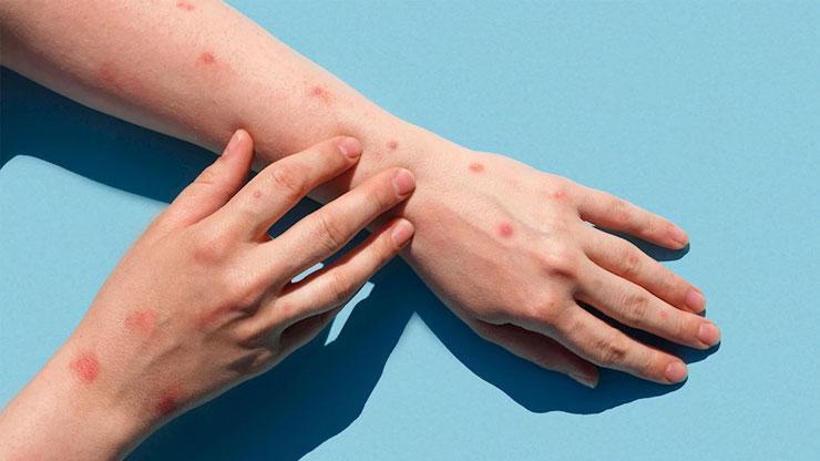 HABER… Sağlık Bakanı Memişoğlu’ndan maymun çiçeği virüsü açıklaması