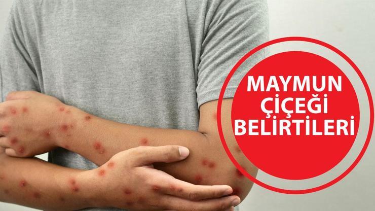 MAYMUN ÇİÇEĞİ BELİRTİLERİ: Maymun çiçeği nasıl bulaşır?