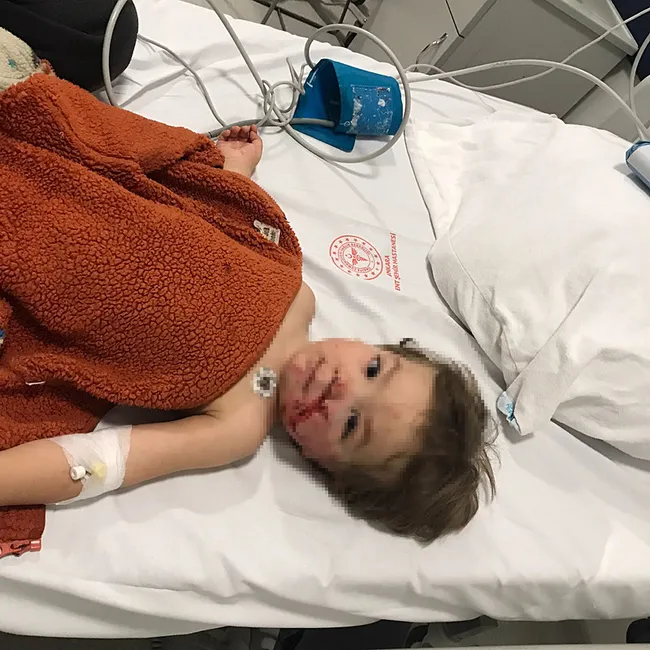 Ankara’da 1,5 ve 5 yaşındaki kardeşler pitbull saldırısına uğradı