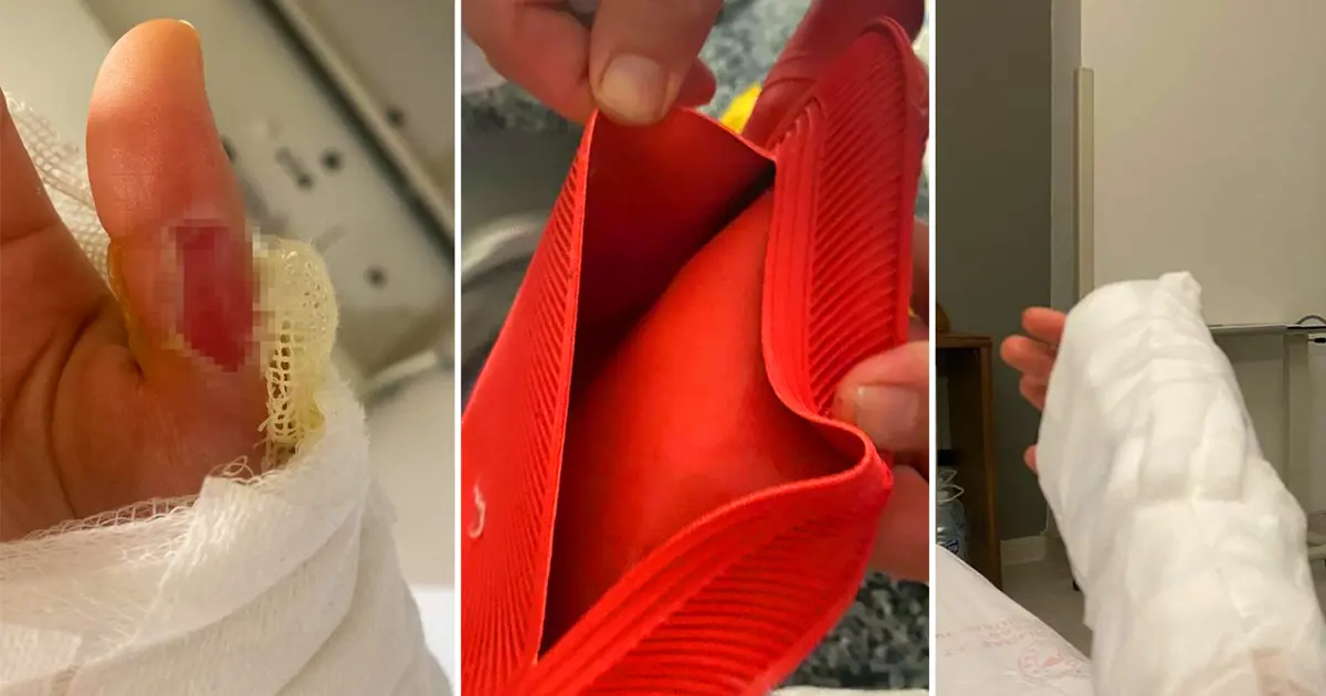 Sıcak su torbası patladı, vücudunun yüzde 25’i yandı