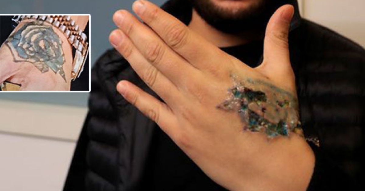 Dövmesini sildirecekti kâbusu yaşadı!