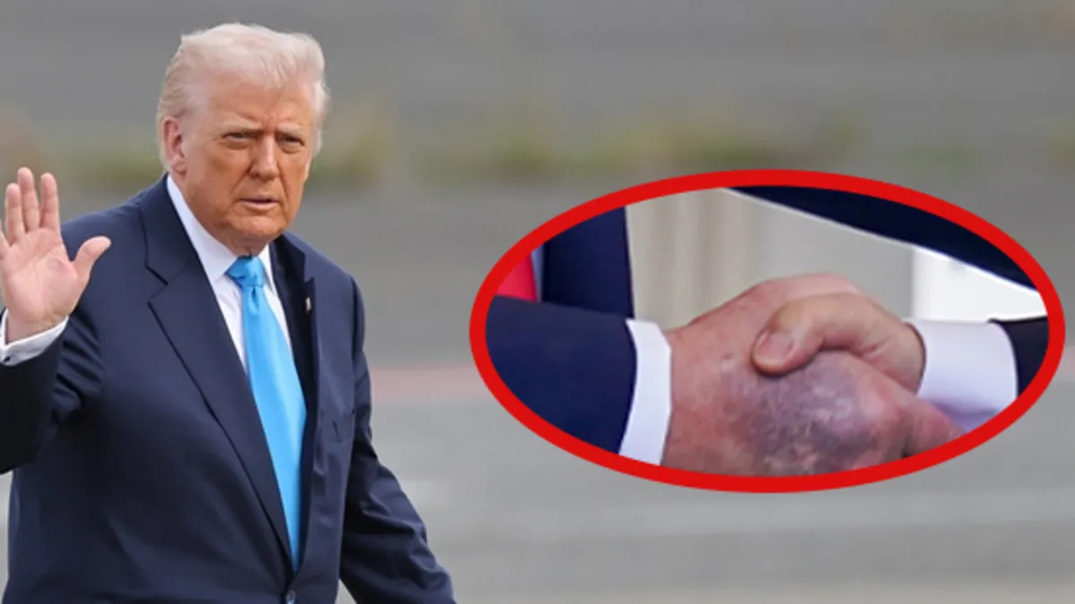 Görüntüsü gündem olmuştu! Trump’ın elindeki morlukların nedeni belli oldu