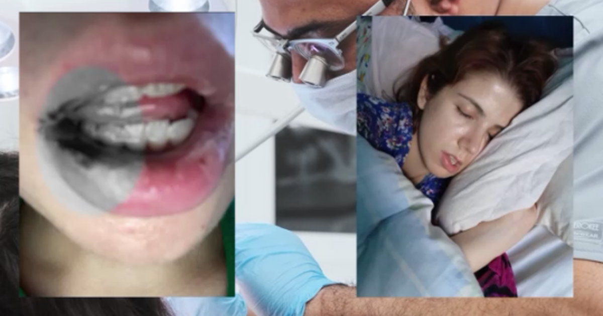 Kanal tedavisi yaptırdı, hayatı kabusa döndü: “İki yıl paslı demirle yaşamışım”