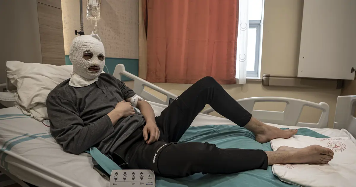 Çakmak gazı tüpü elinde patladı. Bütün yüzü ve göğsü yandı