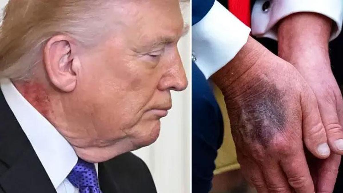 Önce eli şimdi de boynu: Trump’ın doktorunda açıklama